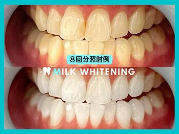 ミルクホワイトニング 久留米店(Milkホワイトニング)/施術例