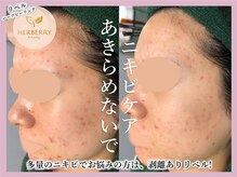 ハーバリー ハーブピーリング 大阪梅田店(HERBERRYハーブピーリング)/梅田ハーブピーリングHERBERRY