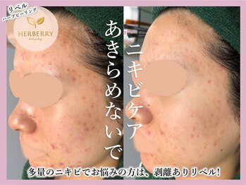 ハーバリー ハーブピーリング 大阪梅田店(HERBERRYハーブピーリング)/梅田ハーブピーリングHERBERRY