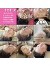 【モニター限定価格】美容鍼（推奨プラン）13200円→8800円に！