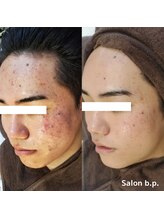 ビーピー 渋谷(b.p.)/ニキビケア　ハーブピーリング