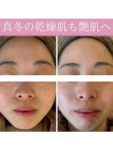 ミエル(miel)/【ハーブピーリング】毛穴ケア