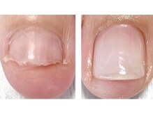 オズ ネイルアンドアイ(OZ NAIL&EYE)/深爪縦長補正3カ月後☆
