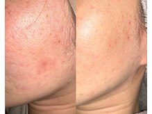 ル シーニュ/美肌 アップデート