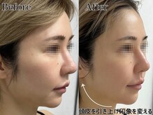 プルチャームエクイデム(Pulchram equidem)/新常識たるみケア「頭皮リフト」