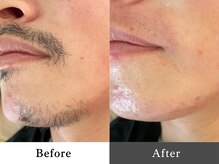 メンズオージー 岡山中区(men's O.G)/メンズ脱毛｜ひげ脱毛