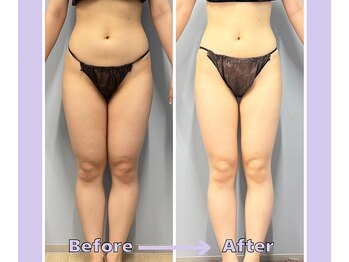 ベルミーランド 浜松天王/痩身Before→After