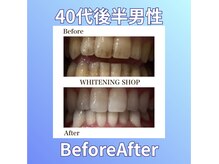 ホワイトニングショップ 西原店/40代後半男性☆BeforeAfter
