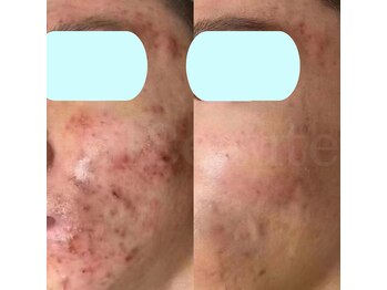 プリュボーテ(Pul Beaute)/ハーブピーリング