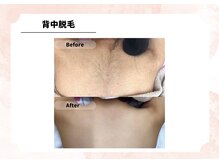 アルゴ 福津店(ALGO)/【背中】光脱毛　