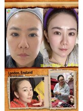 ステップイン(Step in)/ダイヤモンドピールプログラム