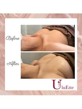 ウルエッテ(UluEtte)/横になってもふっくら/福岡豊胸