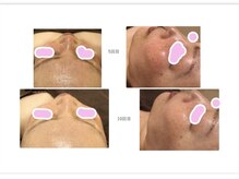 バニーヒップ(Bunny Hip)/カーボキシー