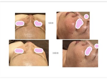 バニーヒップ(Bunny Hip)/カーボキシー