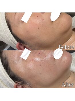 ニュアージュ(Nuage)/美姿勢+肌改善コース1回の変化