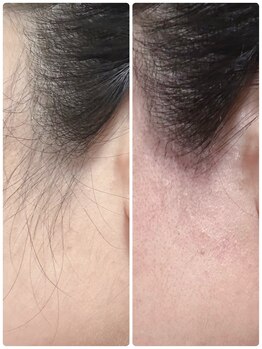 チョコア(CHOCOA)/ワックスでもみあげすっきり★