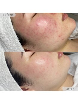 ストーミー(STORMI)/施術3回目 before → after