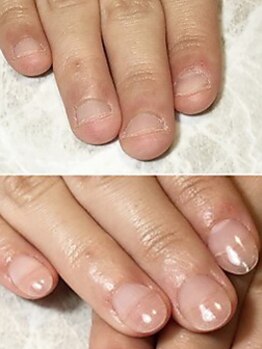 ゆくいの写真/【かみ癖/深爪/巻き爪、お任せください!】口コミでも大好評◇迷うことなくご相談ください♪手/足の爪両方OK