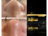 【男の毛穴リセット＆炭酸フェイシャル】毛穴洗浄+炭酸パック