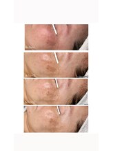 ダチュラ(Da'Chura)/ララピール☆Before→After