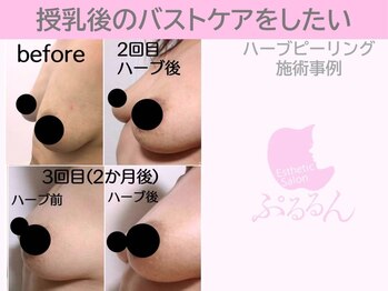 ぷるるんエステ/ハーブピーリング/バストケア