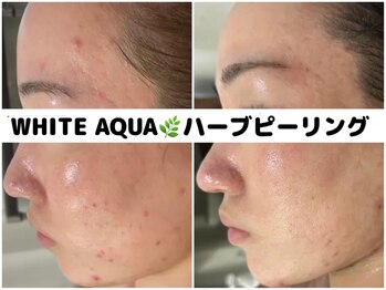 ホワイトアクア 柏店(WHITE AQUA)/ハーブピーリング/肌質改善