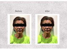 ミセル 尾道店(MYTHEL)/before　after　フェイシャル