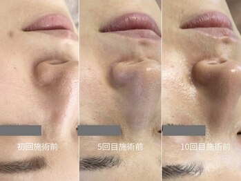 ヒュウ(hue.)/韓国発最新肌管理[セルマン]