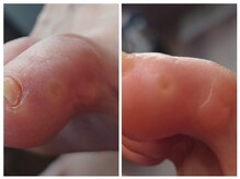 アンティ(Aunty)/人差し指の胼胝