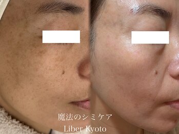 エステティック リベル キョウト 京都駅前店(Esthetic Liber Kyoto)/魔法のシミケア