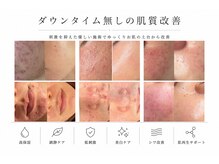 イチロクイチハチ(1618)の雰囲気(低刺激施術で敏感肌やイベント前も◎うんだニキビケアも可能)