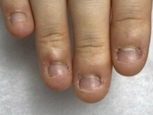 ケイアイエムネイル(KIM nail)/【深爪育成】深爪でお悩みの方◎