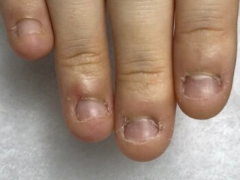 ケイアイエムネイル(KIM nail)/【深爪育成】深爪でお悩みの方◎