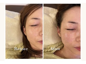 キラリ(Kirari)/【美肌エステ1回の施術】