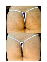 エミルカ(EMILUCA)/ハーブピーリングでお尻綺麗に♪