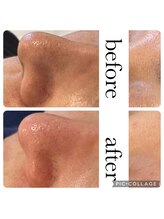 オゾンレメディ(O3remedy)/毛穴エクストラクション