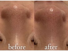 エトワール 駒沢大学駅前店(ETOILE)/肌質改善|毛穴ケア