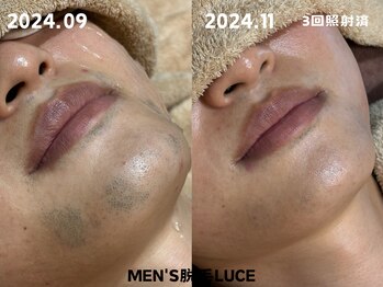 ルーチェ/【ヒゲ脱毛】1回目から実感