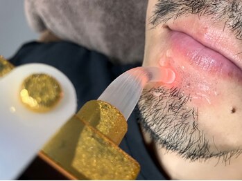アイリー(IRIE)の写真/令和の新常識！メンズ脱毛は当たり前☆青髭対策にも◎お得に脱毛体験♪《髭脱毛初回￥3000(2回まで)》