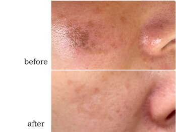 ハクビ(HAKUBI)/シミケア♪