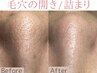 NO.3【本格毛穴改善】マッサージ＆ブレンドハーブピーリング＆パック¥25000→