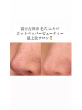 イエナ(IENA)/話題のハイドロ毛穴ピーリング♪