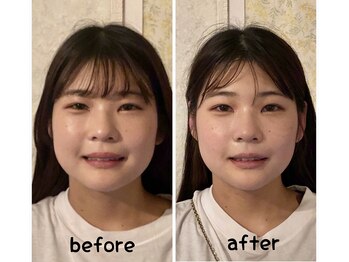 ドクター ヴィーナス/小顔矯正1回の変化
