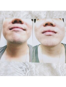 マタマルル(matamaururu)/男性髭のBeforeAfter