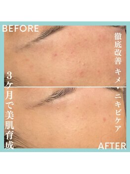 ジュネラ ボーテ(Jenela beaute)/美肌育成