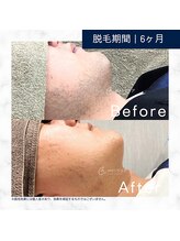 メンズクリア 武蔵小杉店/【メンズクリア】お客様の施術例