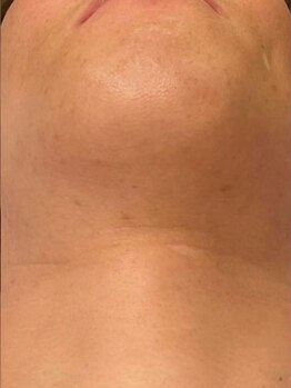 ダリ(Dali)の写真/メンズヒゲ脱毛が人気★お肌のお悩みを解消しながら、清潔感のあるお肌に♪お得なクーポンもあり◎