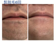マスカレード 品川(Masquerade)/【症例写真】男性髭脱毛6回
