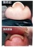 【巻き爪ケアお悩み解消したい方】巻き爪ケア２本コース¥10,500