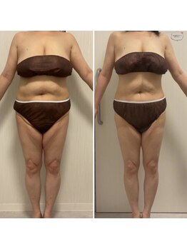 ヴェリティー(Verity)/ビフォーアフター